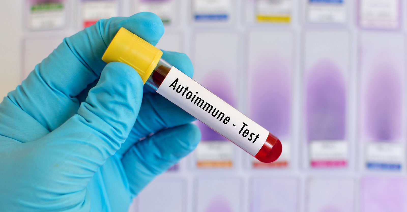 High Incidence of Arthritis and Autoimmune Diseases Found in Children ...